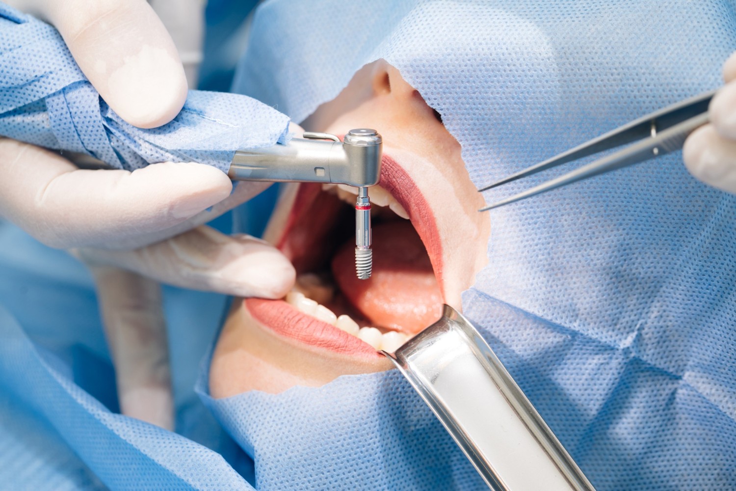 Cirurgia Oral